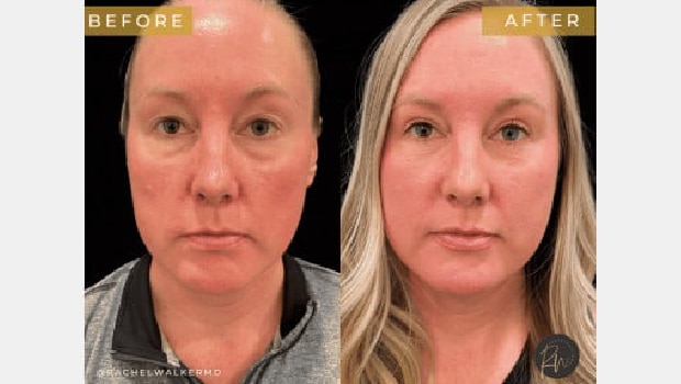 Facial 1