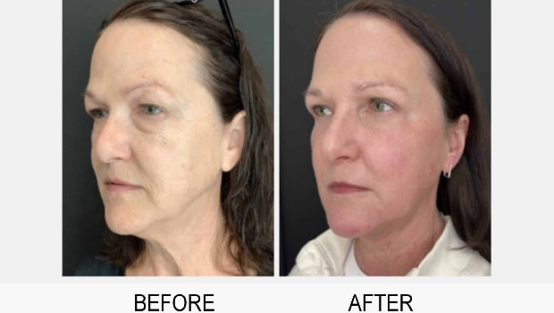 Facial 2