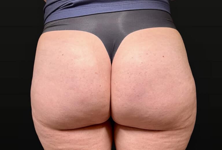 After Image: Case #10354 – Aveli Cellulite Removal - back