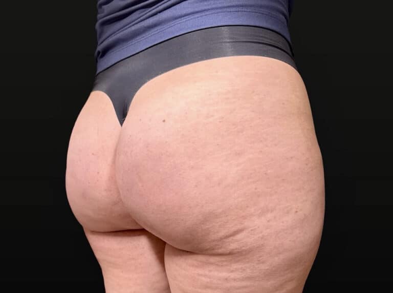After Image: Case #10354 – Aveli Cellulite Removal - right-back-oblique