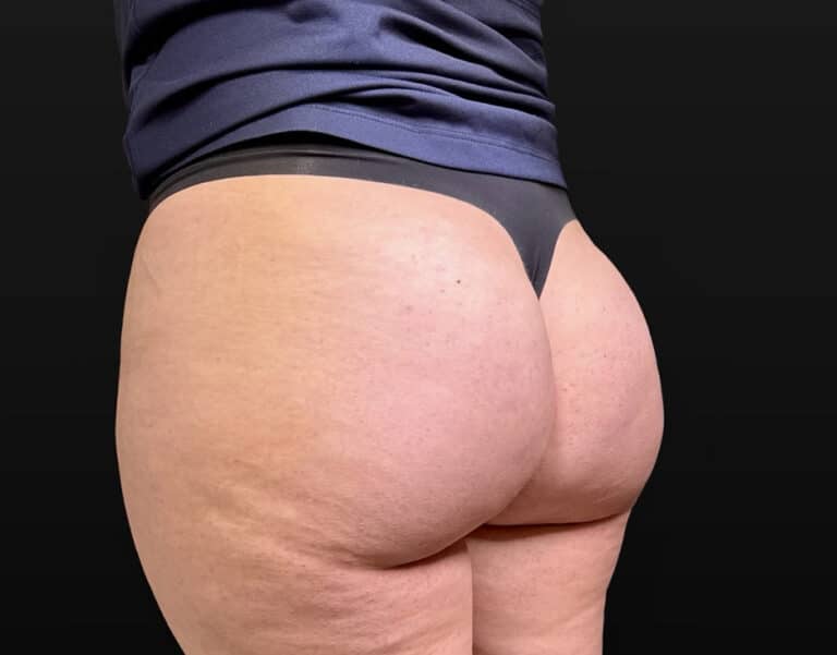After Image: Case #10354 – Aveli Cellulite Removal - left-back-oblique