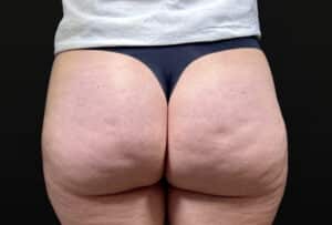 Before Image: Case #10354 – Aveli Cellulite Removal