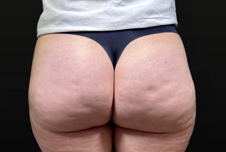 Before Image: Case #10354 – Aveli Cellulite Removal - back