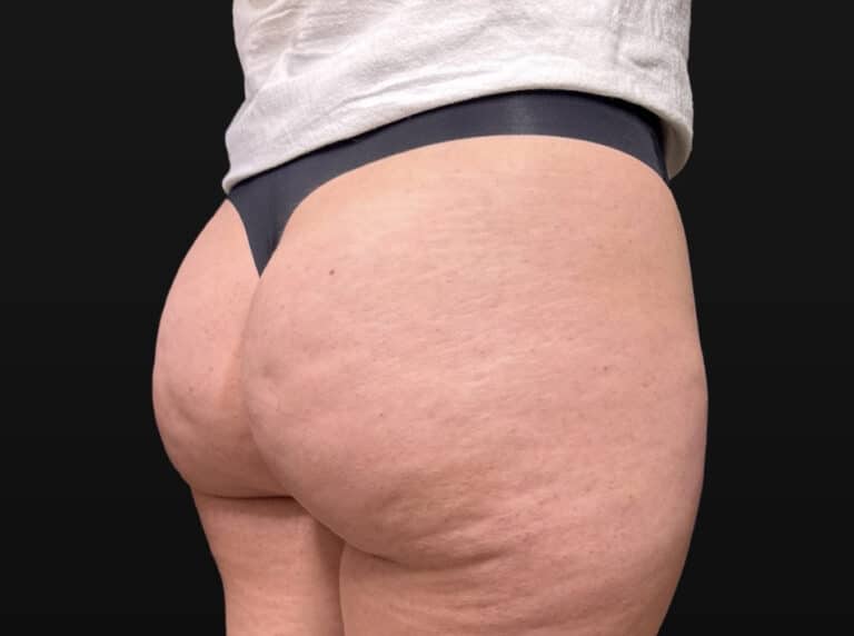 Before Image: Case #10354 – Aveli Cellulite Removal - right-back-oblique