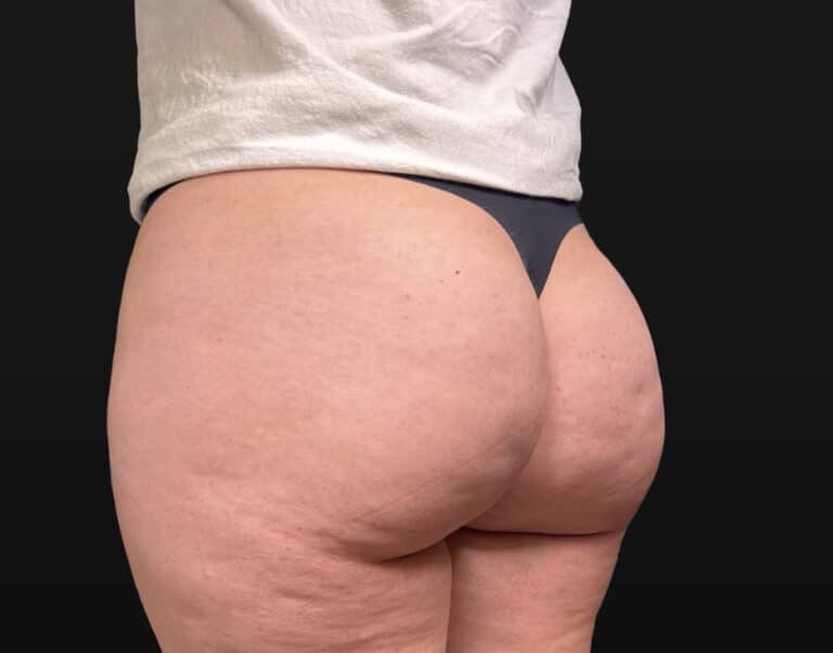 Before Image: Case #10354 – Aveli Cellulite Removal - left-back-oblique