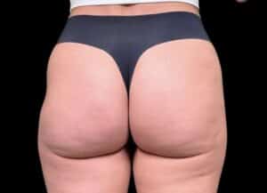After Image: Case #10355 – Aveli Cellulite Removal