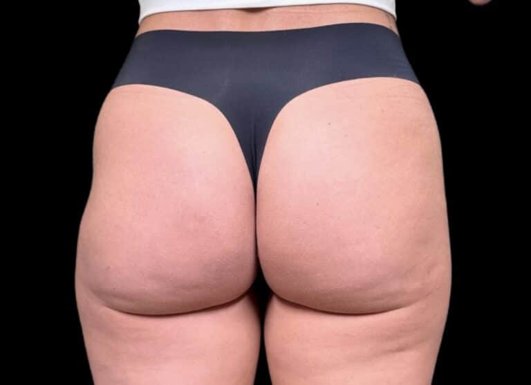 After Image: Case #10355 – Aveli Cellulite Removal - back