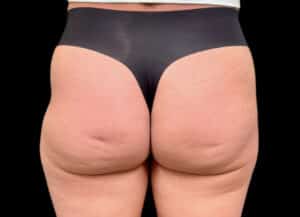 Before Image: Case #10355 – Aveli Cellulite Removal