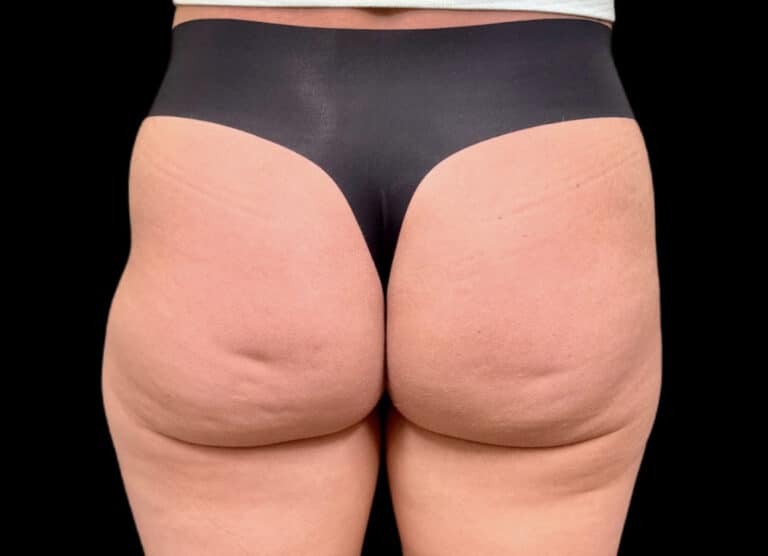 Before Image: Case #10355 – Aveli Cellulite Removal - back