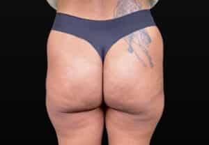 After Image: Case #10383 – Aveli Cellulite Removal