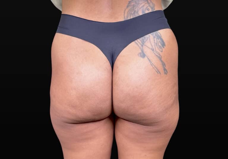After Image: Case #10383 – Aveli Cellulite Removal - back