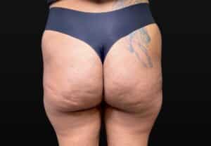 Before Image: Case #10383 – Aveli Cellulite Removal