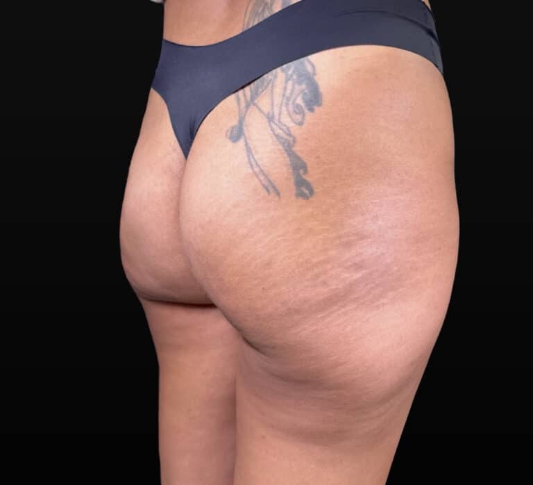 After Image: Case #10383 – Aveli Cellulite Removal - right-back-oblique