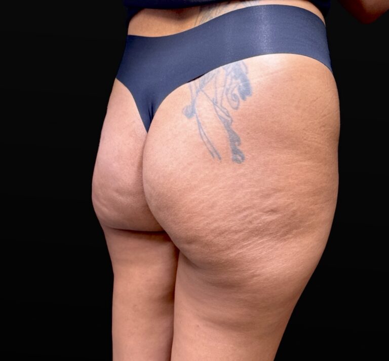 Before Image: Case #10383 – Aveli Cellulite Removal - right-back-oblique
