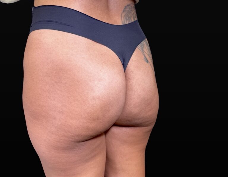 After Image: Case #10383 – Aveli Cellulite Removal - left-back-oblique