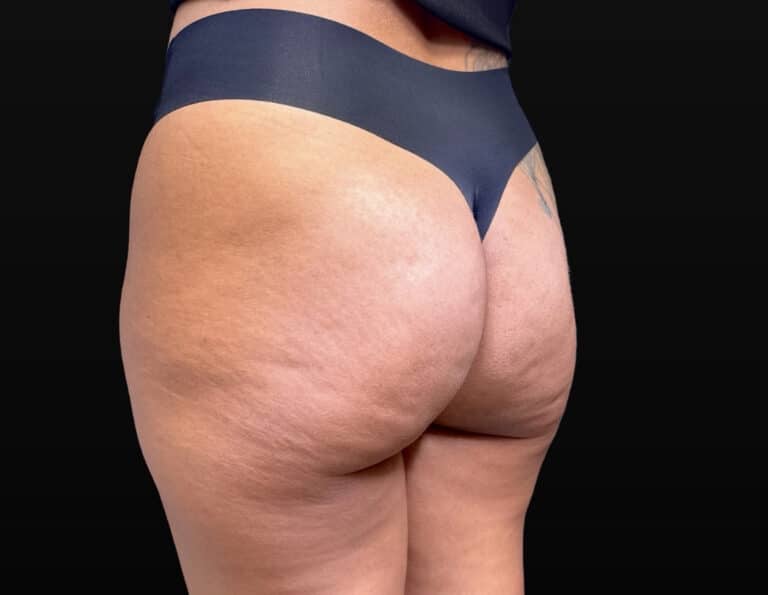 Before Image: Case #10383 – Aveli Cellulite Removal - left-back-oblique