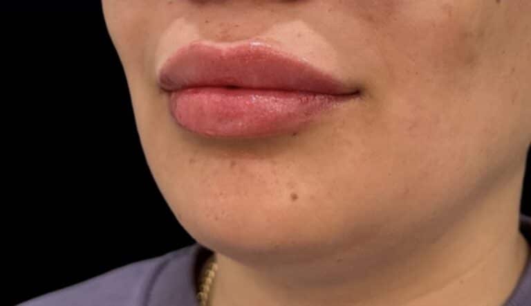 After Image: Case #10391 – Lip Filler - left-front-oblique