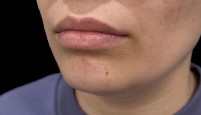 Before Image: Case #10391 – Lip Filler - left-front-oblique