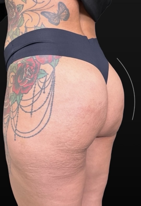 After Image: Case #10376 – Alloclae - left-back-oblique