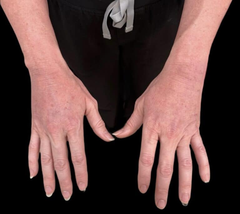 After Image: Case #10377 – Alloclae - front