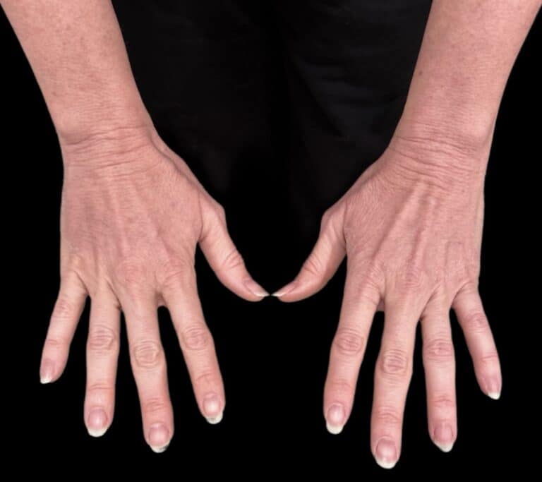 Before Image: Case #10377 – Alloclae - front