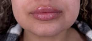 After Image: Case #10366 – Lip Filler