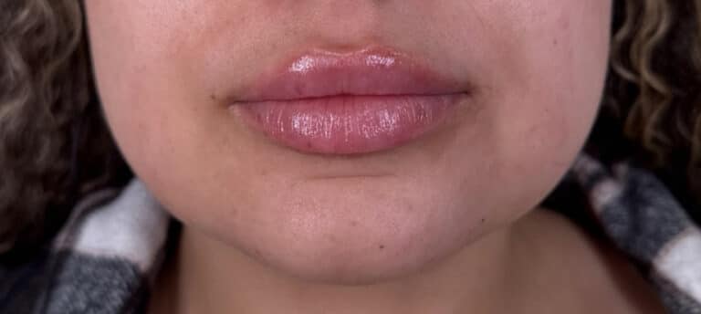 After Image: Case #10366 – Lip Filler - front