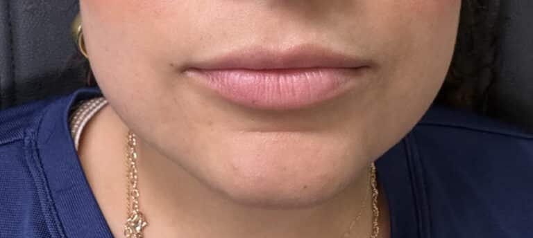 Before Image: Case #10366 – Lip Filler - front