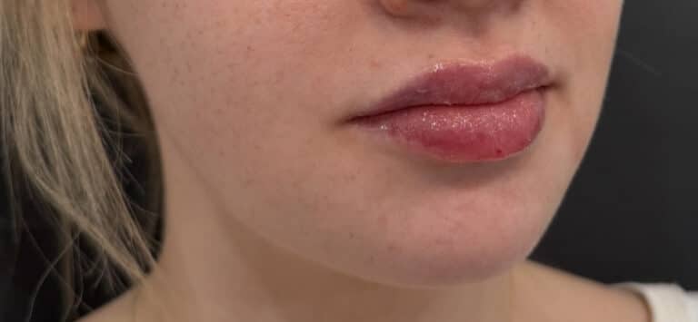 After Image: Case #10367 – Lip Filler - right-front-oblique