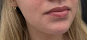 Before Image: Case #10367 – Lip Filler