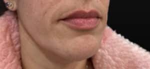 After Image: Case #10368 – Lip Filler Fully Healed