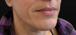 Before Image: Case #10368 – Lip Filler Fully Healed