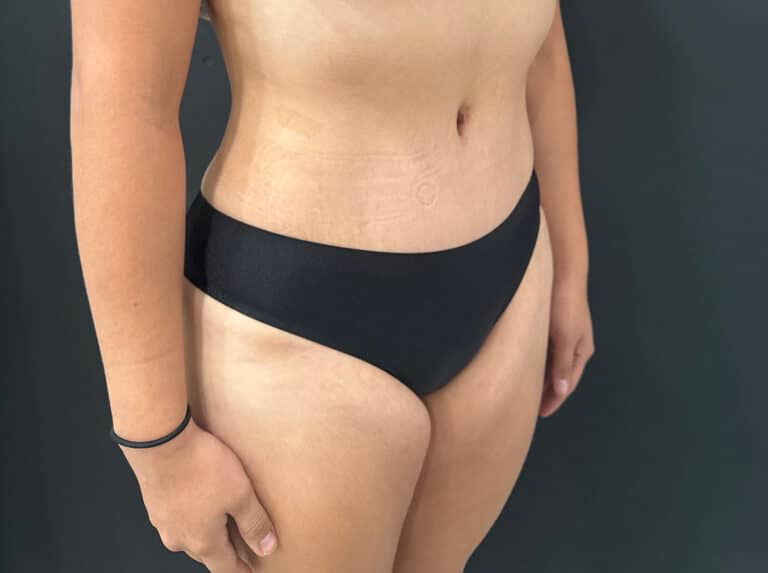 After Image: Case #8364 – Abdominoplasty (Tummy Tuck) with SAFELipo of Circ Trunk - right-front-oblique