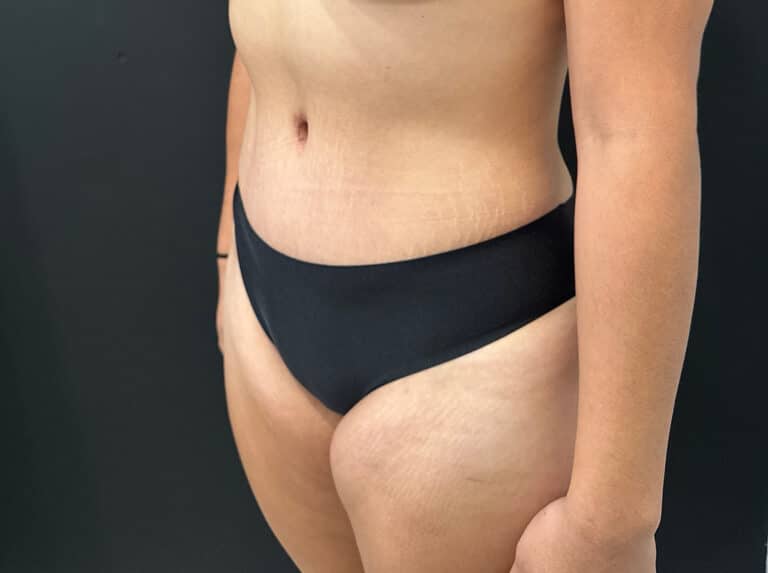 After Image: Case #8364 – Abdominoplasty (Tummy Tuck) with SAFELipo of Circ Trunk - left-front-oblique