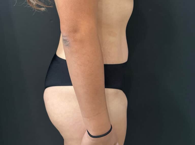 After Image: Case #8364 – Abdominoplasty (Tummy Tuck) with SAFELipo of Circ Trunk - right-side