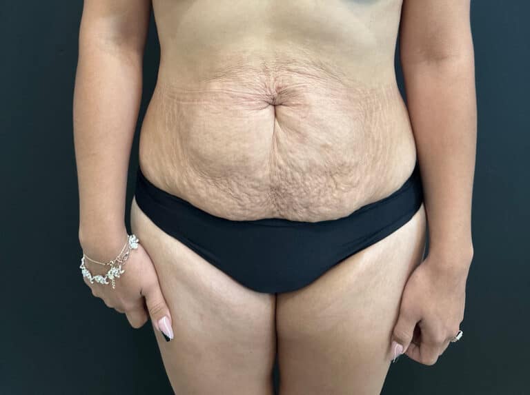 Before Image: Case #8364 – Abdominoplasty (Tummy Tuck) with SAFELipo of Circ Trunk - front