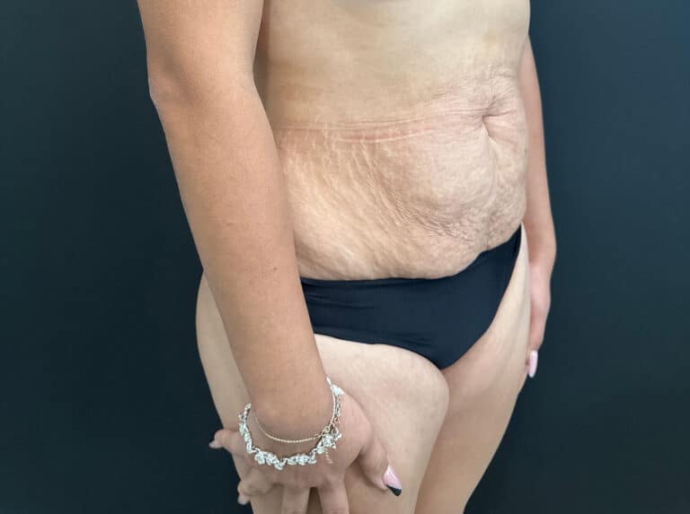 Before Image: Case #8364 – Abdominoplasty (Tummy Tuck) with SAFELipo of Circ Trunk - right-front-oblique