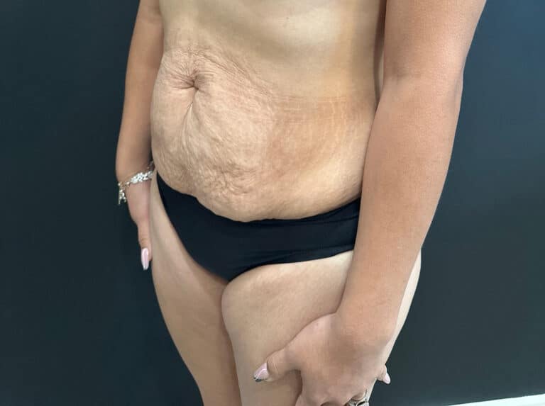 Before Image: Case #8364 – Abdominoplasty (Tummy Tuck) with SAFELipo of Circ Trunk - left-front-oblique