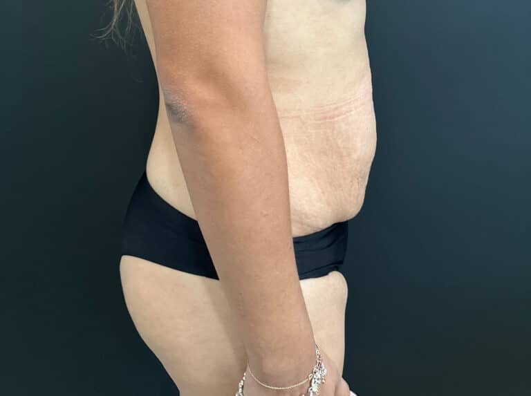 Before Image: Case #8364 – Abdominoplasty (Tummy Tuck) with SAFELipo of Circ Trunk - right-side