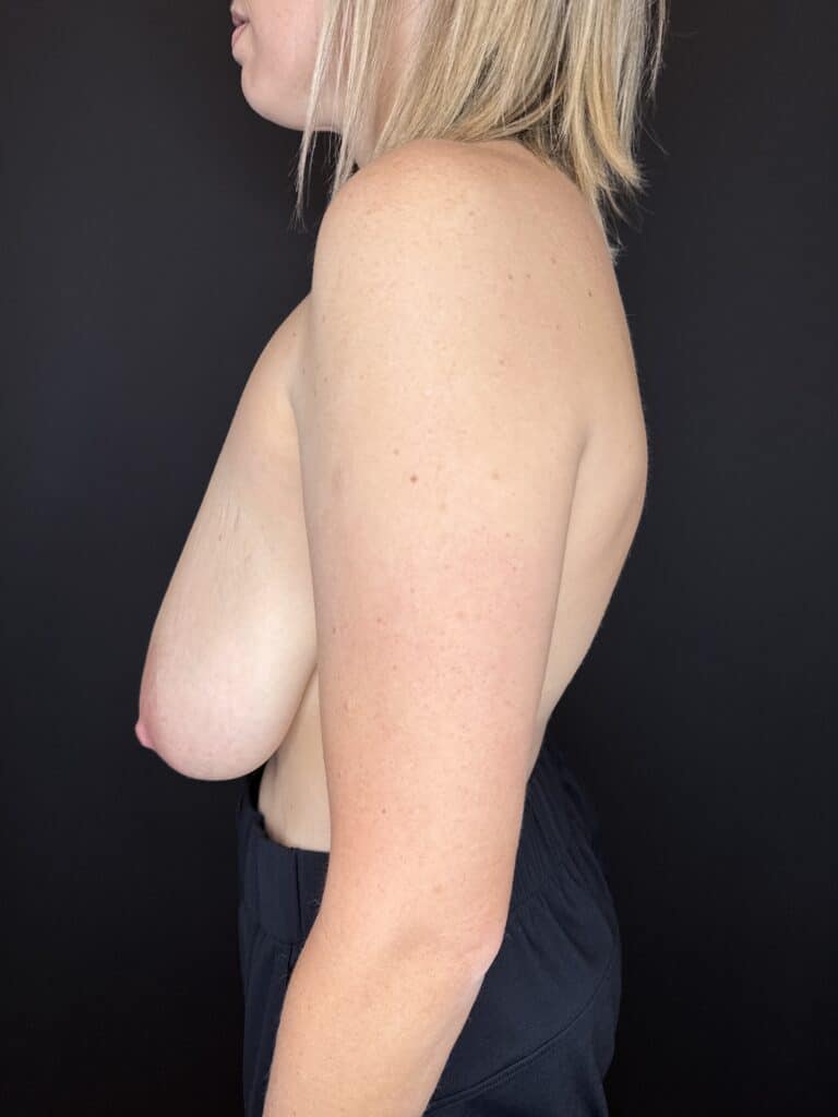 Before Image: Case #10494 – Breast Reduction - left-side