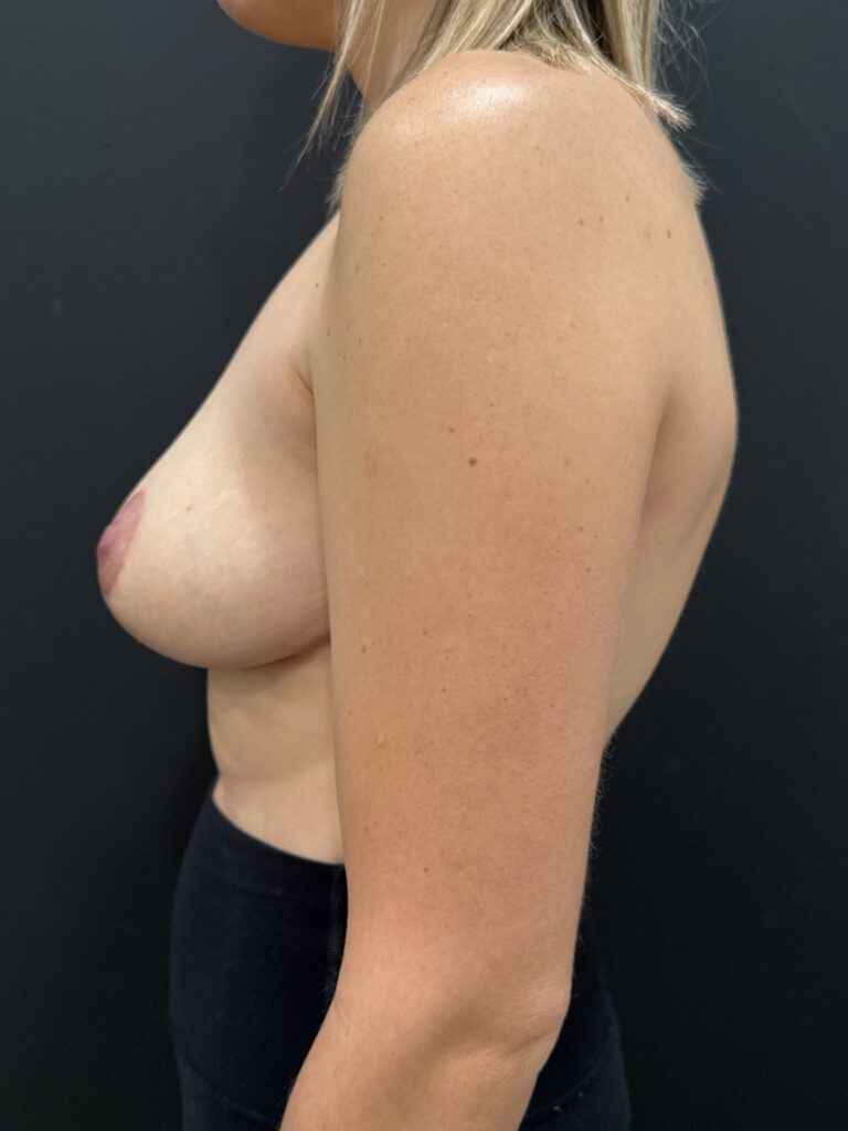 After Image: Case #10494 – Breast Reduction - left-side