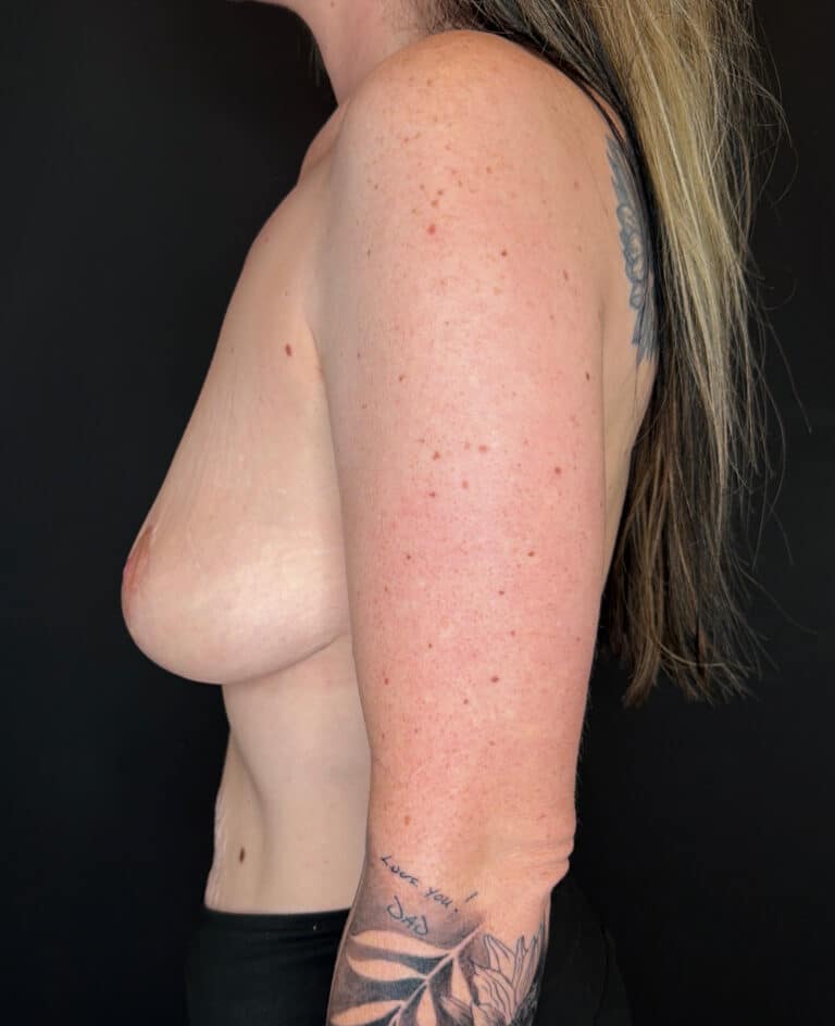 After Image: Breast Reduction - left-side