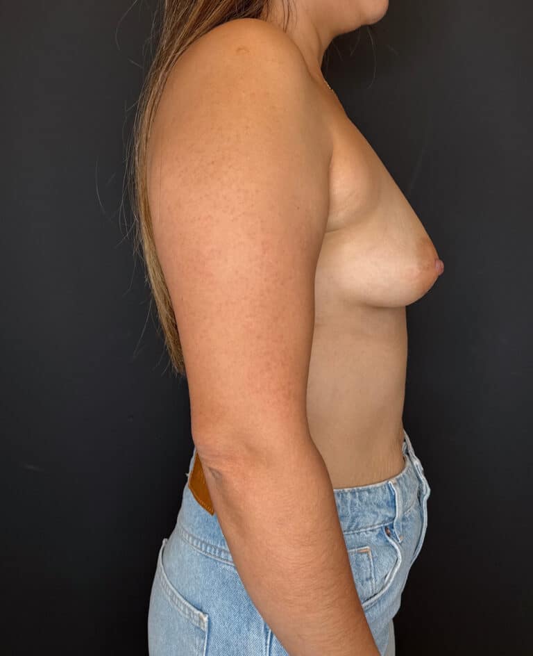 Before Image: Breast Augmentation - right-side