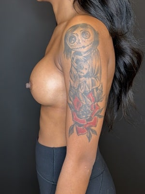 After Image: Case #10522 – Breast Augmentation - left-side