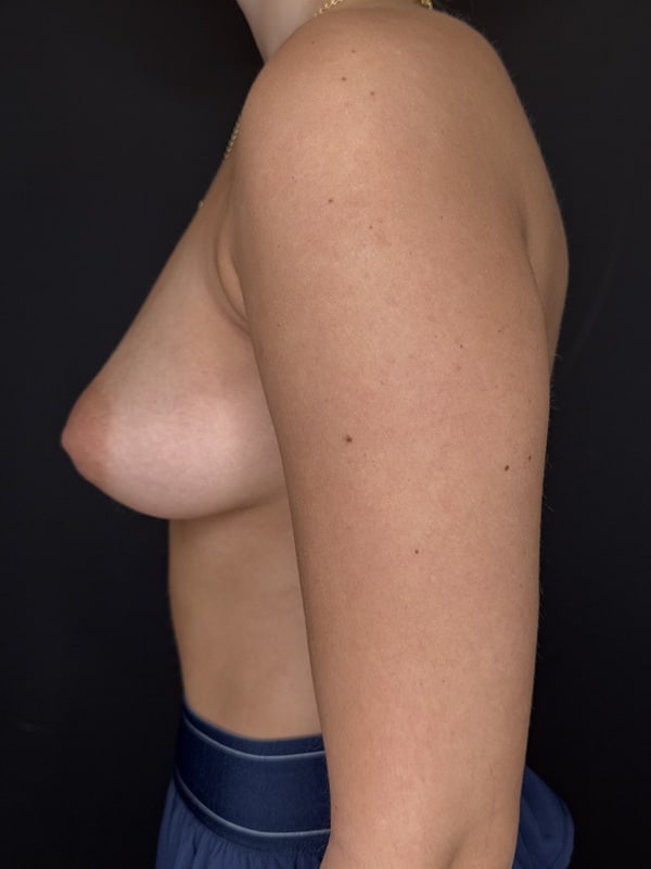 Before Image: Case #10525 – Breast Augmentation - left-side