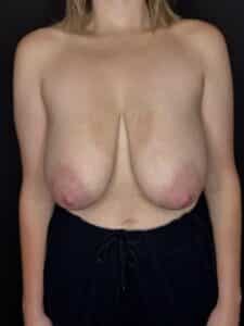Before Image: Case #10494 – Breast Reduction