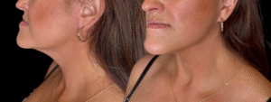 After Image: Case #10617 – Lower Face and Neck Lift