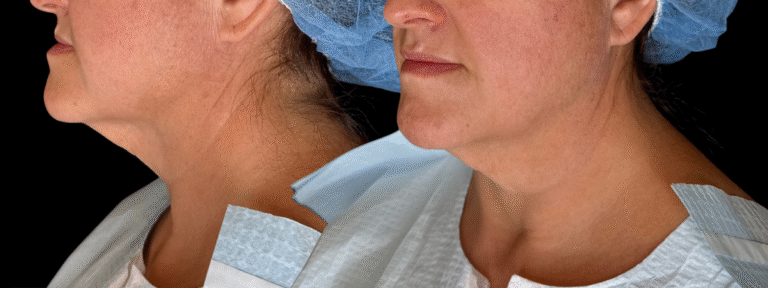 Before Image: Case #10617 – Lower Face and Neck Lift - other