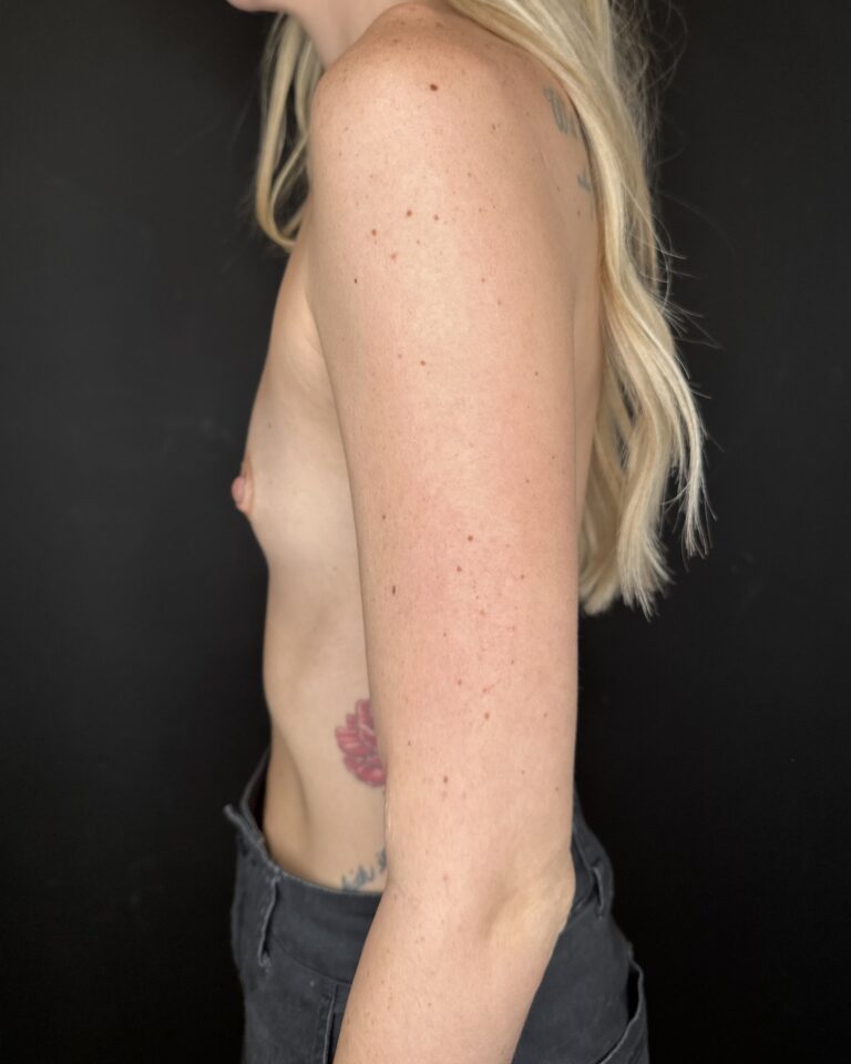 Before Image: Case #10600 – Breast Augmentation - left-side