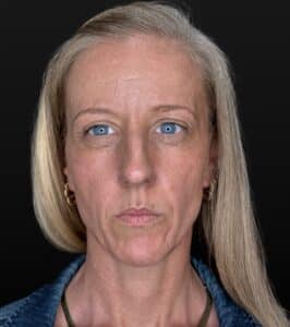 Before Image: Case #10523 – Mid and Lower face filler, Lip filler